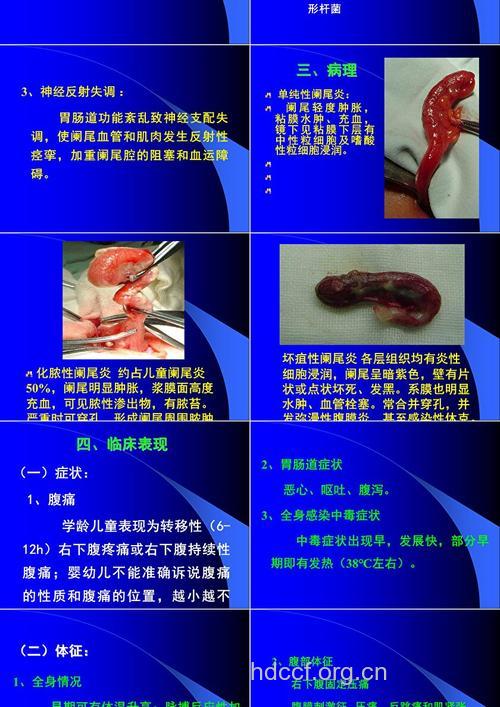 小儿急性阑尾炎的病因病理