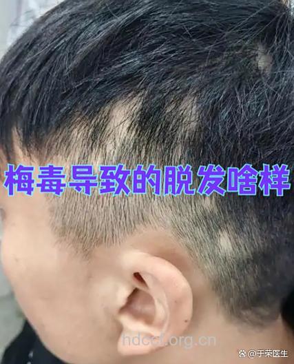 脱发会是乙肝的并发症吗?