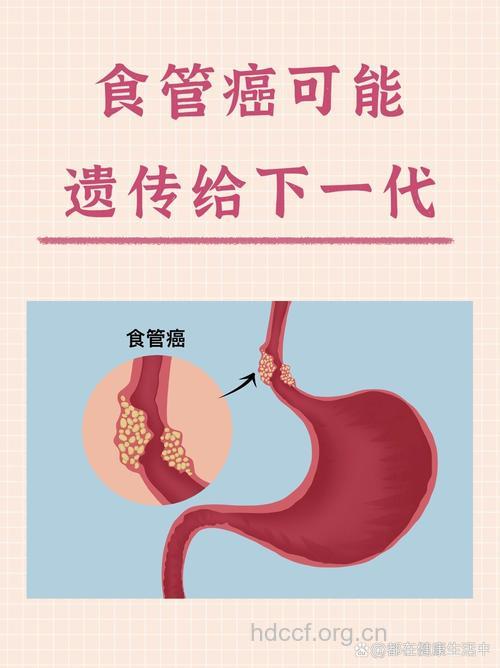 食道癌：会遗传下一代吗
