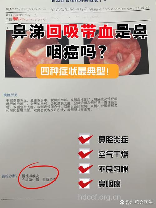 涕血 鼻咽癌的5个早期症状