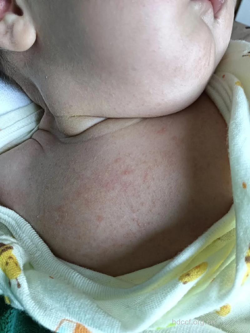 婴儿得乙肝有哪些症状