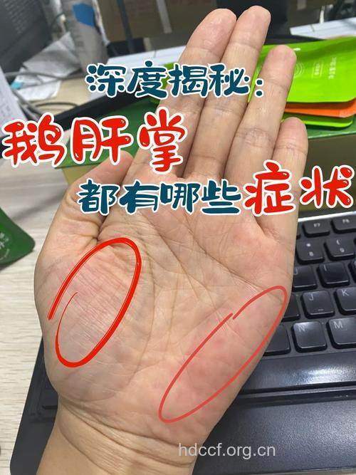 手上出现哪些症状提示有肝病