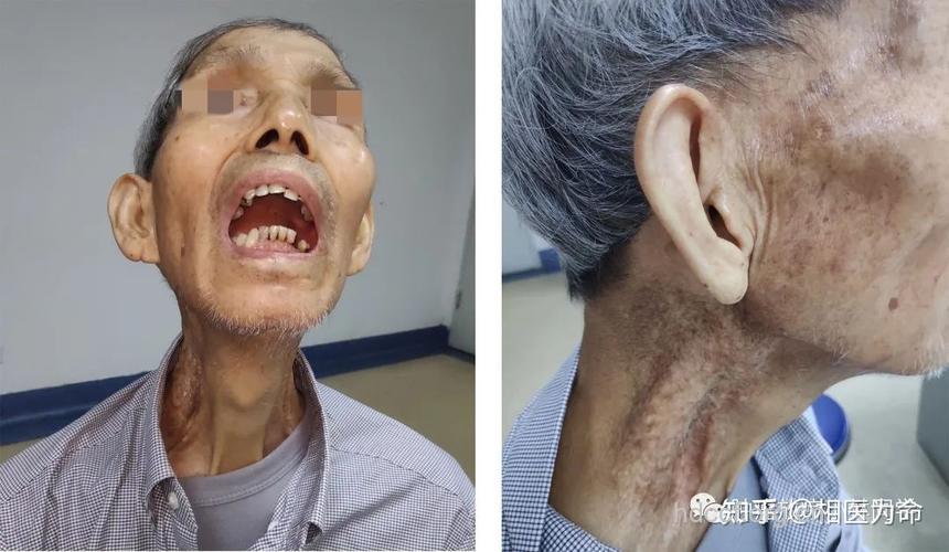 鼻咽癌放射治疗的反应