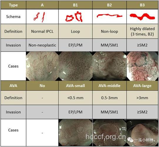 内镜判断食管表浅癌浸润深度