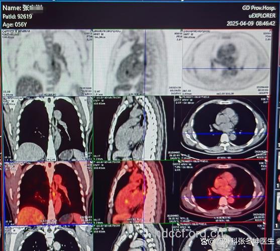 食管癌的早期发现
