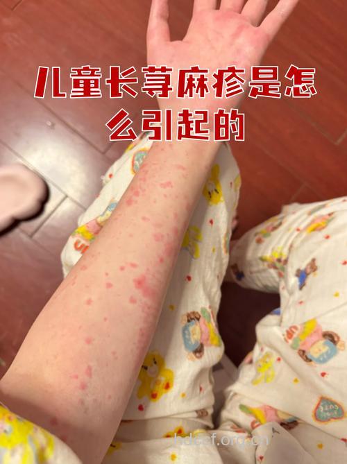 儿童也易患荨麻疹