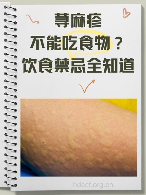 荨麻疹多数由贪吃引起
