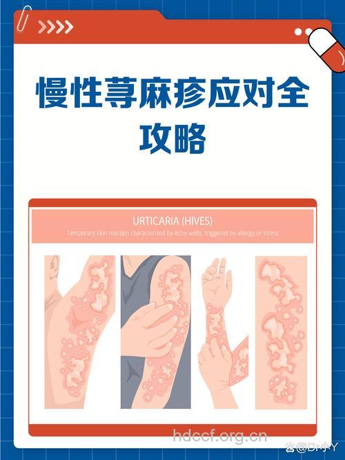 慢性荨麻疹发病机制有哪些？