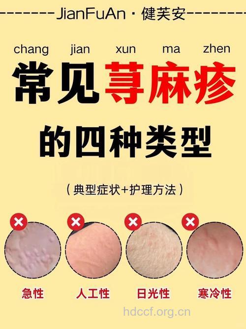 小心 这些让你惹上荨麻疹