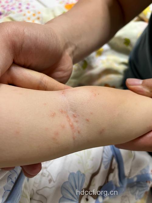 孩子胳膊有疙瘩 警惕是风疹块