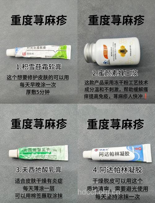 口服、外擦疗法 巧治荨麻疹