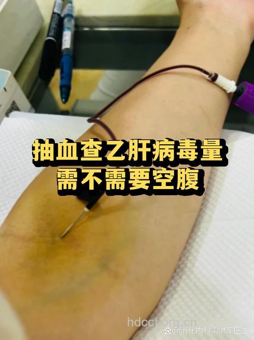 抽血有感染乙肝的可能吗