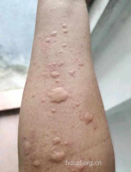 让人忧愁的慢性荨麻疹