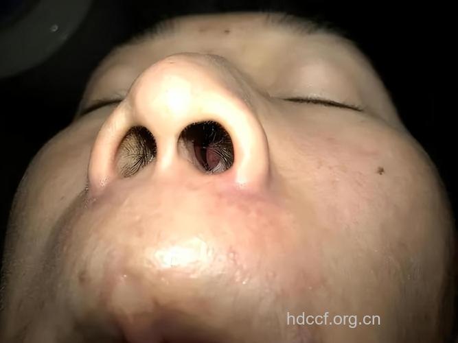 鼻咽肿瘤的早期症状