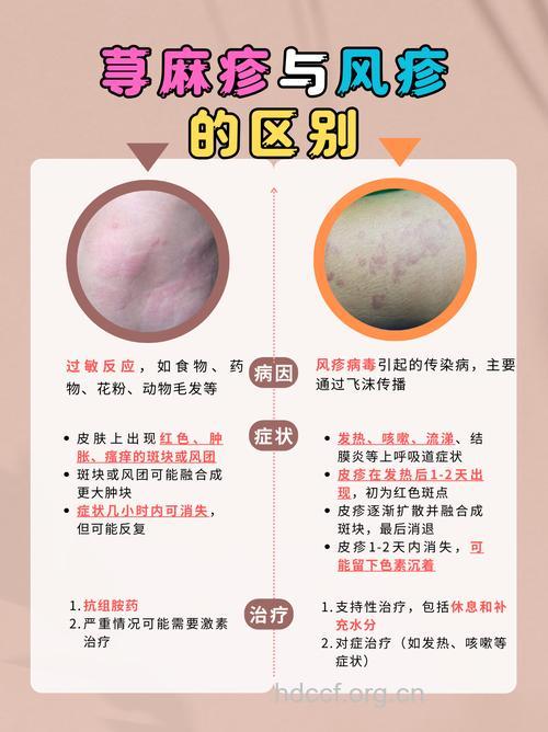 与荨麻疹“和平共处”之道