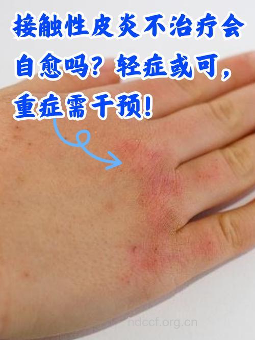 接触性皮炎病因有两点 症状是什么