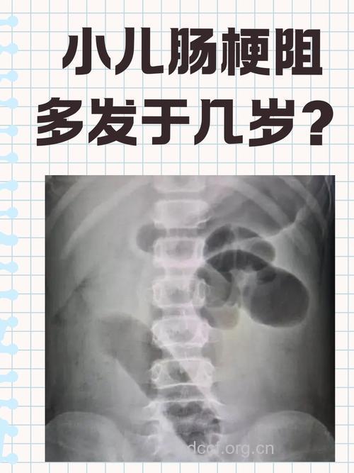 硬币导致肠梗阻