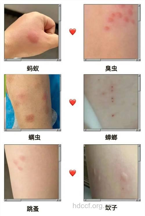 虫咬性皮炎千万不要用手挠抓