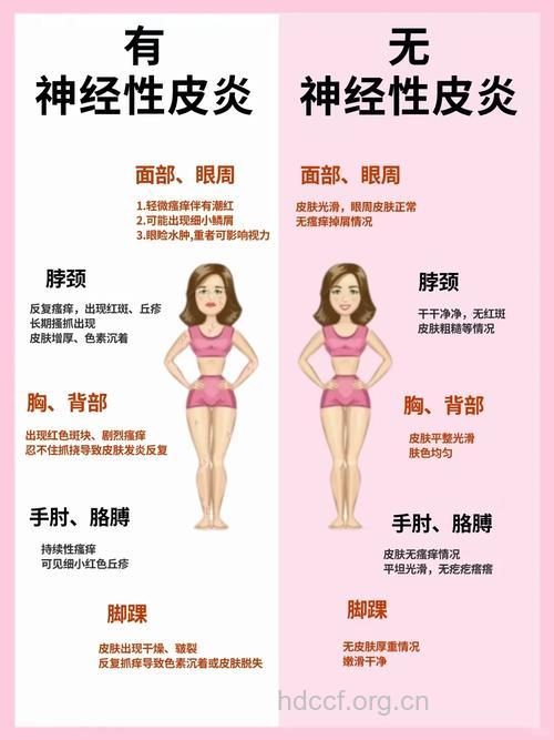 放松心情可防止神经性皮炎复发