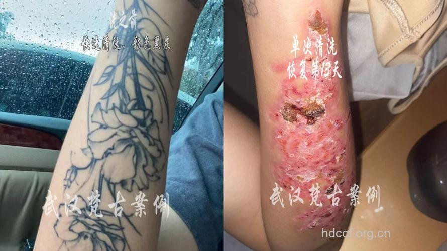 彩绘纹身需警惕皮炎 如何护理