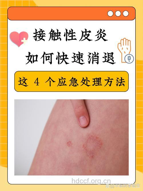 接触性皮炎的确诊方法