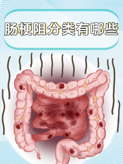 哪些是假性肠梗阻
