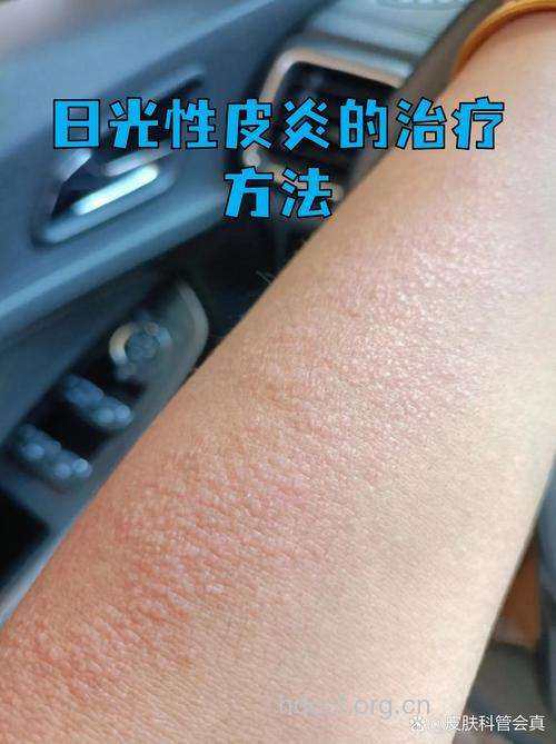 为什么会形成日光性皮炎