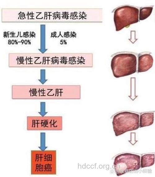 乙肝恶化分几个阶段呢
