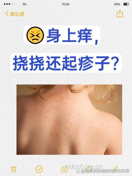 怎么穿衣服会导致接触性皮炎