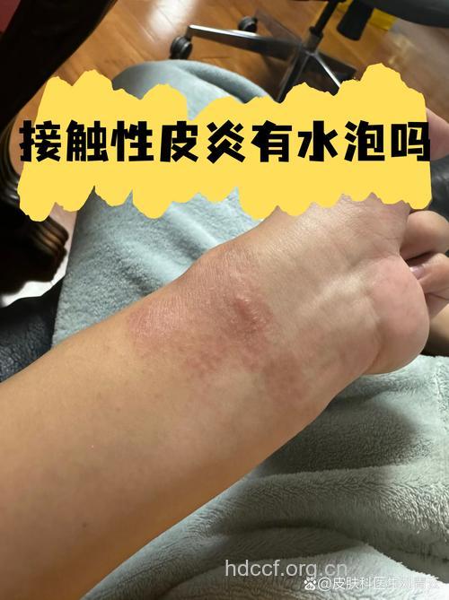 哪些物质会导致接触性皮炎