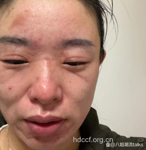 使用面膜会导致接触性皮炎