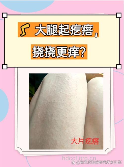 牛仔裤为什么会导致皮肤过敏