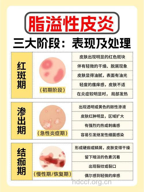 脂溢性皮炎的家庭护理