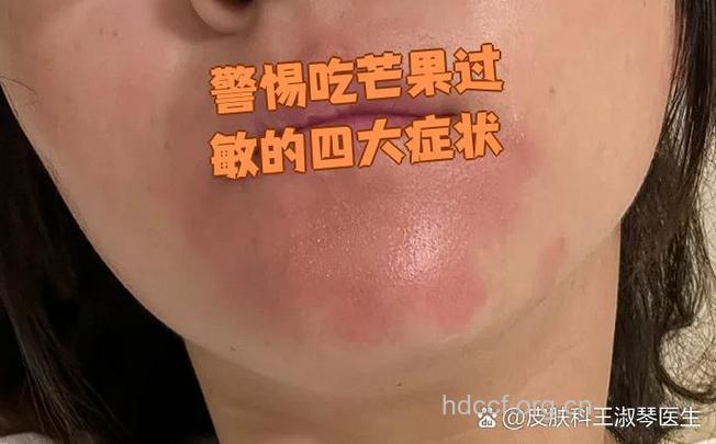 注意鲜芒果引起皮炎