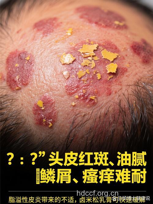 使用化妆品致皮炎 香料最“毒”