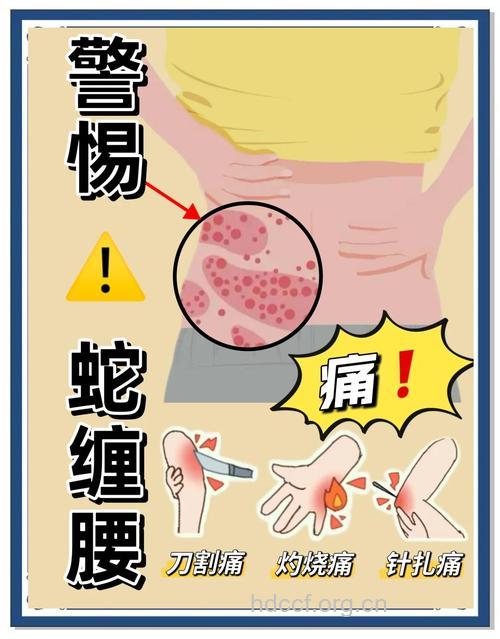缠腰带小心皮炎缠上你