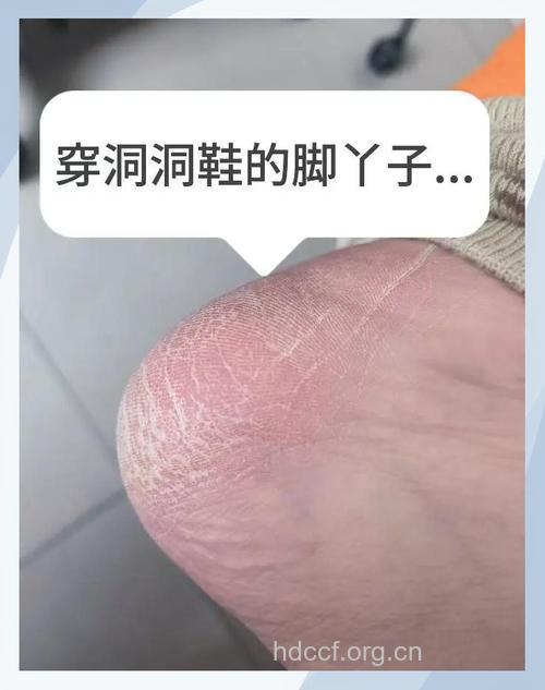 小心洞洞鞋诱发接触性皮炎