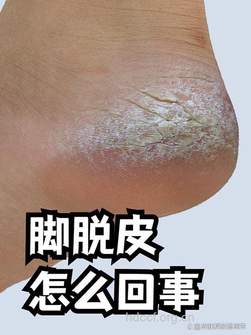 修脚小心乙肝交叉感染