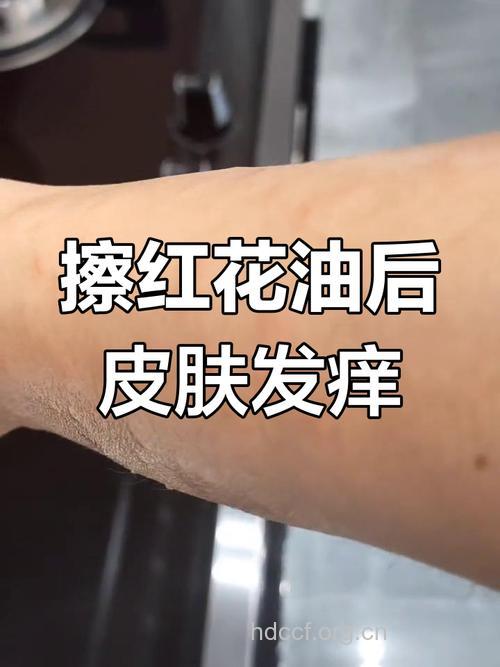 注意:涂红花油会得接触性皮炎