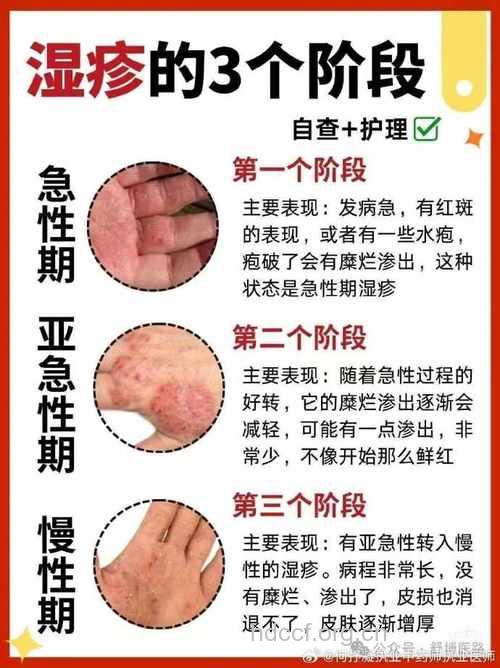 慢性湿疹危害大 及时治疗是关键