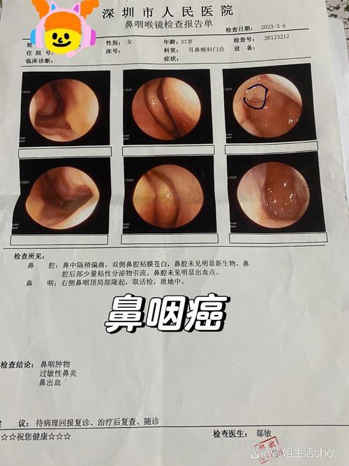 鼻咽癌的晚期症状表现