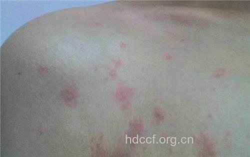 乙肝患者的皮肤是什么样的