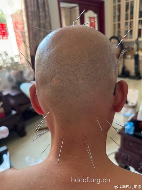 鼻咽癌的针灸治疗