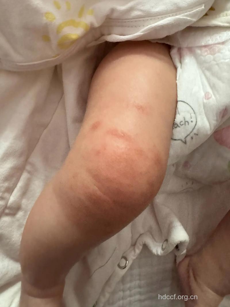 宝宝腿部湿疹需早治疗