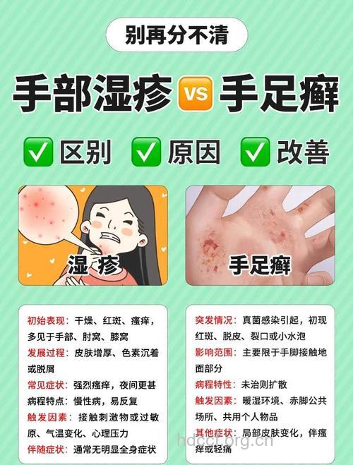 手部湿疹的发病与职业有关 如何预防