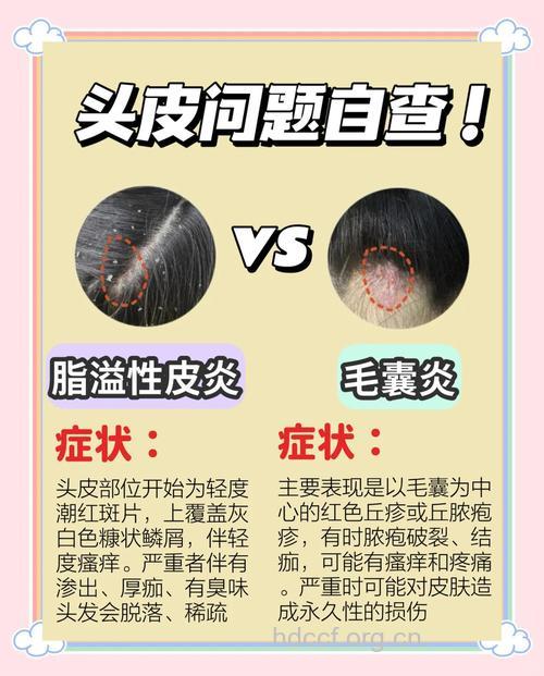 脂溢性皮炎要与其它疾病区分