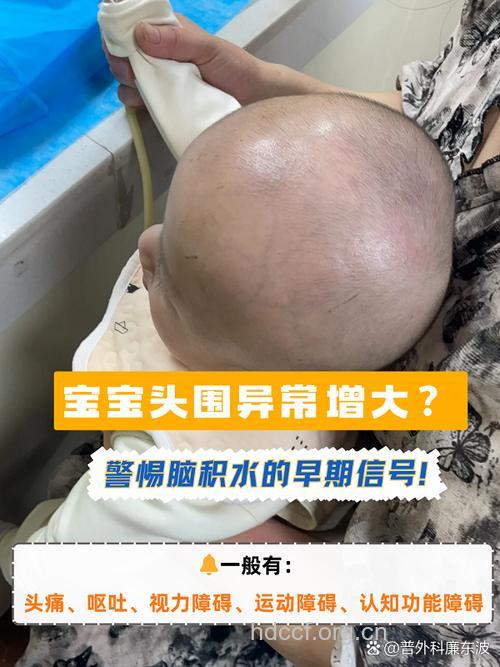 先天性脑积水的症状体征和治疗方法