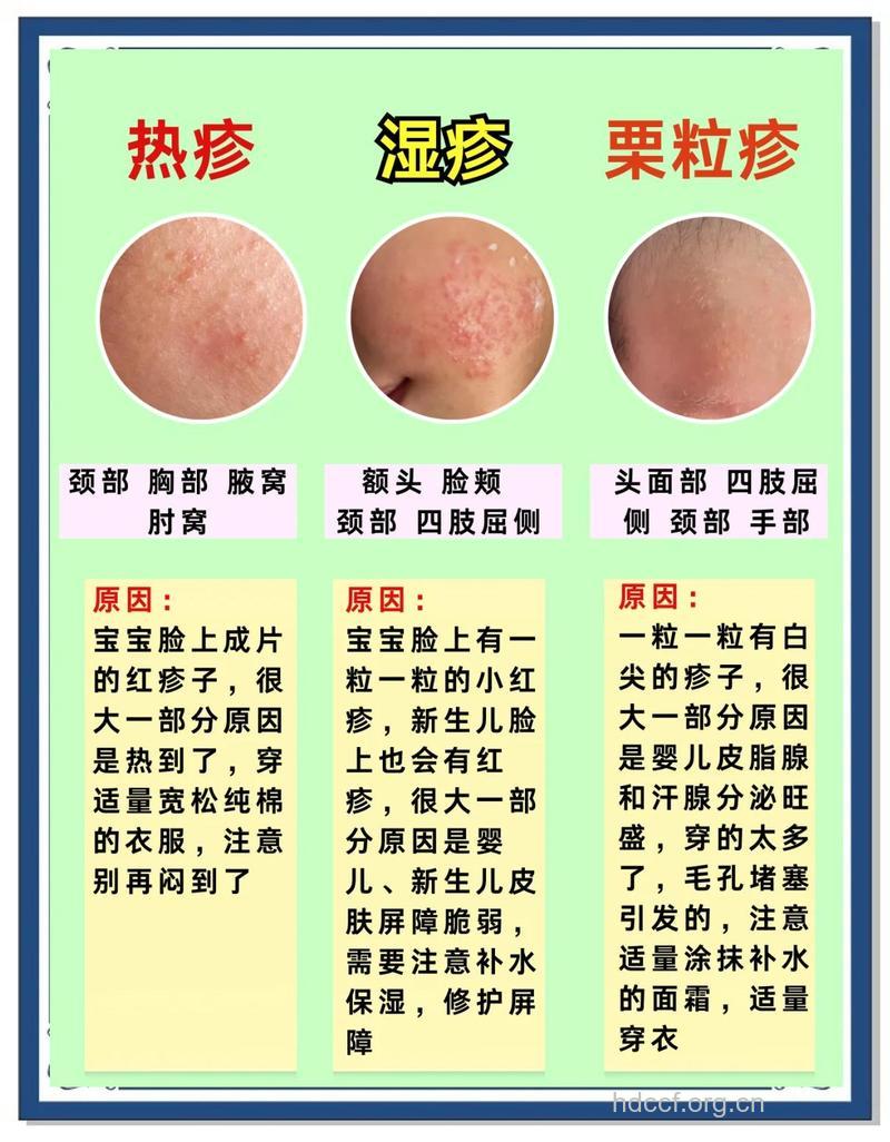 小儿湿疹的两大类型