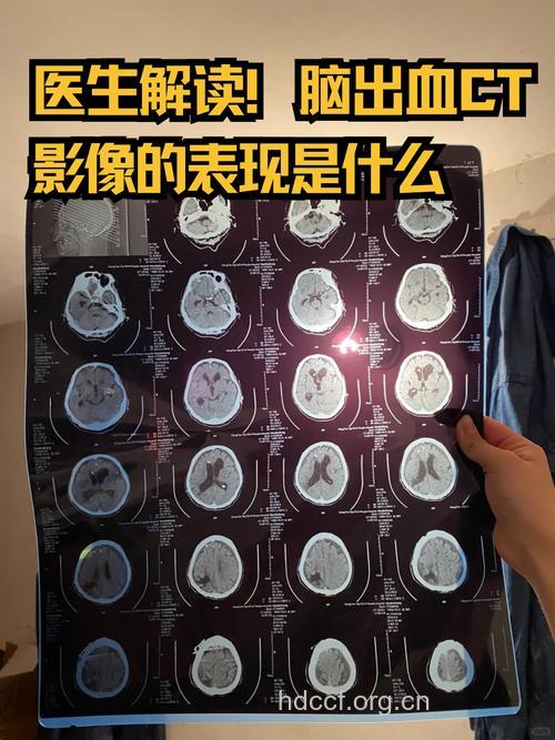 头脑外伤为什么要做CT检查