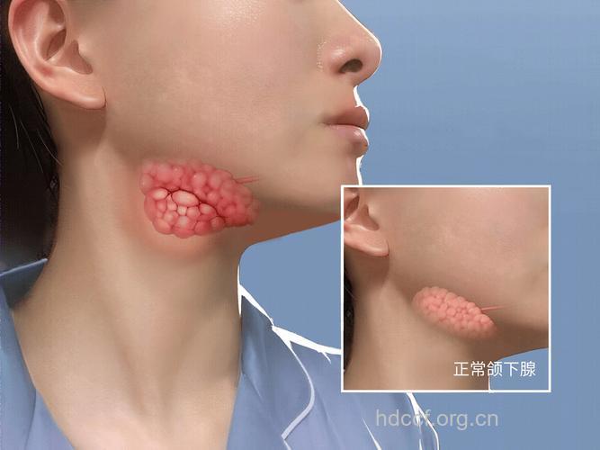 有哪些头颈部恶性肿瘤